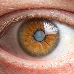 Glaucoma 